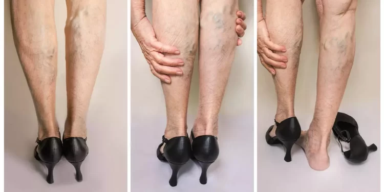 Ölüme kadar götürüyor! Bacak varislerine dikkat etmezseniz…